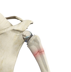 Shoulder_topic_heading - Condition