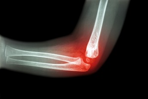 Elbow_topic_heading - Condition