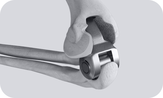 Elbow Reconstruction