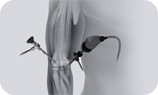 Elbow Sports Injuries