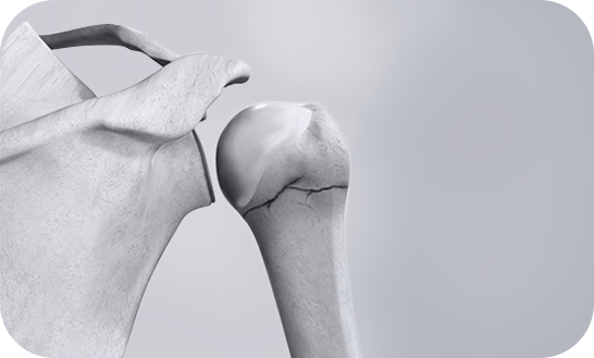 Shoulder Fractures
