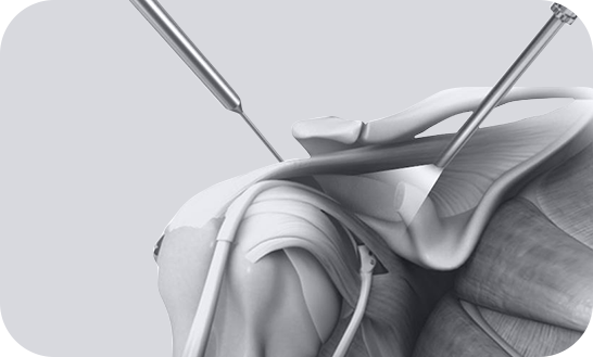 Shoulder Instability