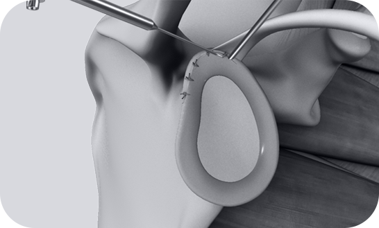 Other Shoulder Injuries