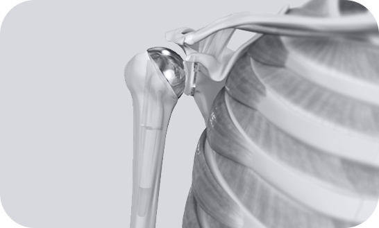 Shoulder Replacement