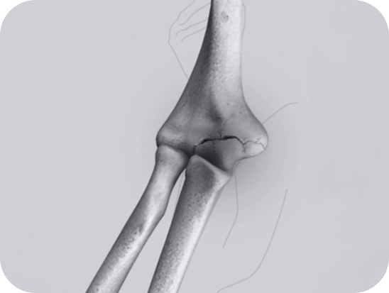 Arthroscopic surgery