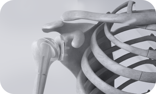 shoulder replacement