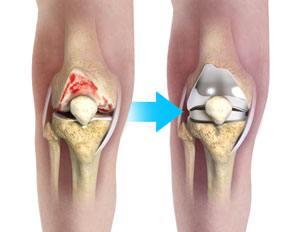 Complex Total Knee Replacement pic