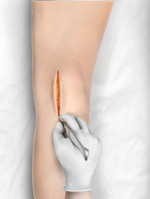 Minimally Invasive Knee Joint Replacement pic