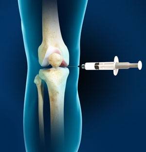 Nonsurgical Knee Treatments pic
