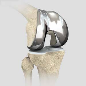 Outpatient Total Knee Replacement pic