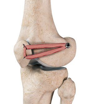 Patellofemoral Knee Replacement pic