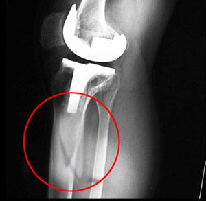 Periprosthetic Knee Fractures pic