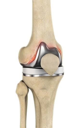 Periprosthetic Knee Infection pic