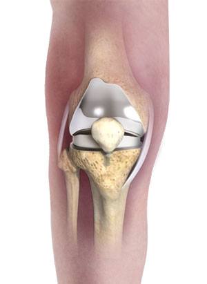 Primary Knee Replacement pic