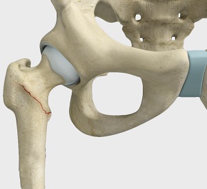 Proximal Femoral Fracture pic