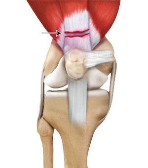 Quadriceps Tendon Rupture pic