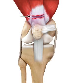 Quadriceps Tendon Rupture and Repair pic