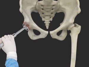 Robotic Assisted Hip Replacement pic