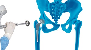 Robotic Total Hip Replacement pic