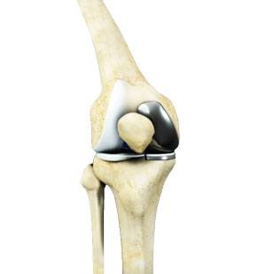 Unicondylar Knee Replacement pic