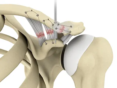 AC Joint Repair Images