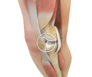 ACL Tears Images