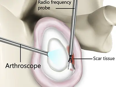 Capsular Release Images