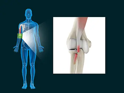 Distal Biceps Injuries Images