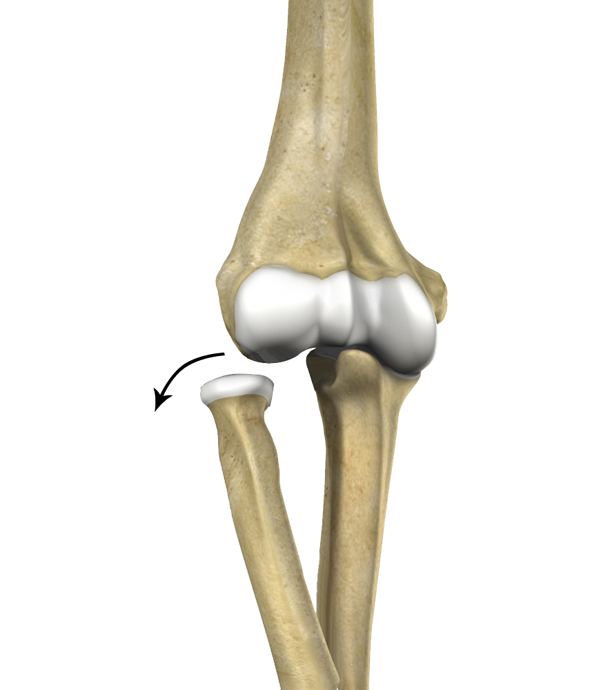 Elbow Dislocation Images