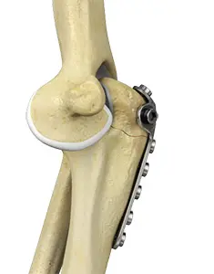 Elbow Fracture Reconstruction Images