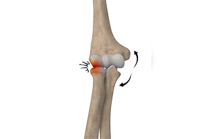 Elbow Impingement Images
