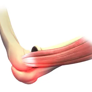 Elbow Sprain Images