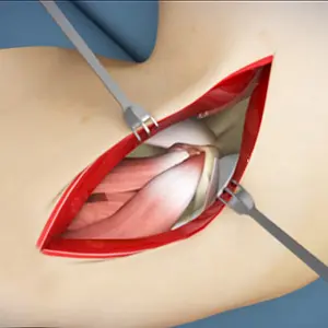 Elbow Surgery Images