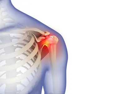 Frozen Shoulder Images