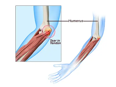 Golfer's Elbow Images