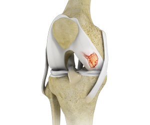 Knee Cartilage Restoration Images