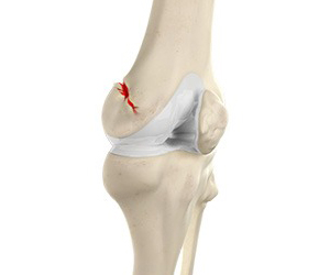 Knee Fracture Images