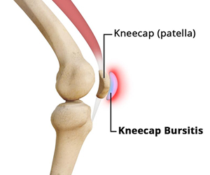 Kneecap Bursitis Images