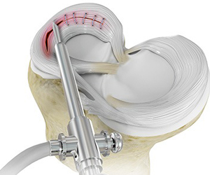 Meniscal Surgery Images