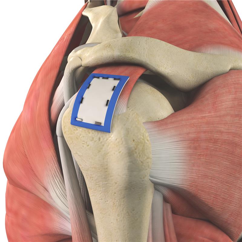 Patch Augmentation for Rotator Cuff Repair Images