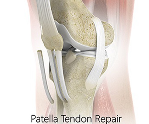 Patellar Tendon Repair Images