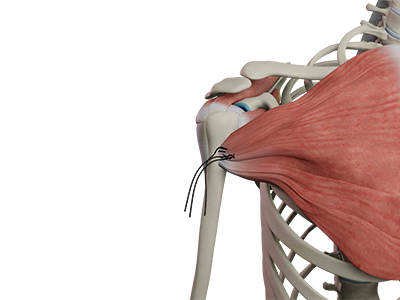 Pectoralis Major Tendon Transfer Images