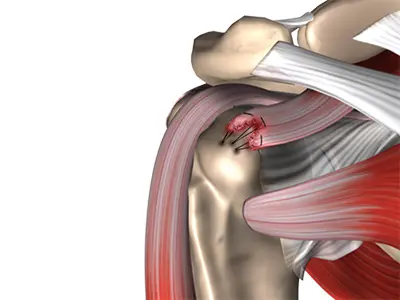 Rotator Cuff Repair Images
