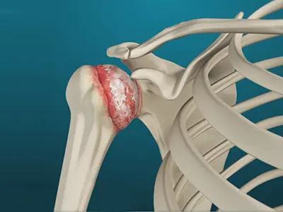 Arthritis of the Shoulder Images