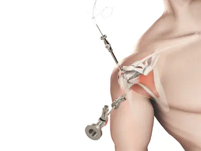 Shoulder Arthroscopy Images