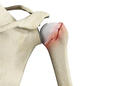 Shoulder Fracture Images