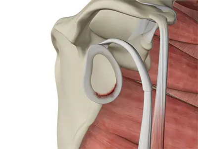 Shoulder Labral Tear Images