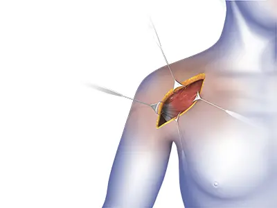 Shoulder Surgery Images