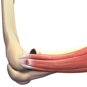 Tennis Elbow Images