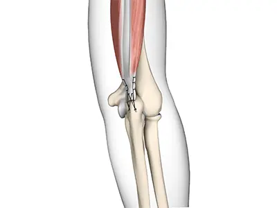 Triceps Repair Images